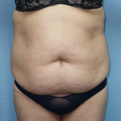 Tummy Tuck Before & After Patient #245