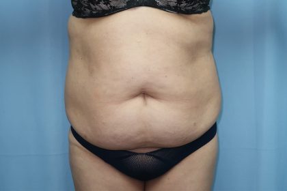 Tummy Tuck Before & After Patient #245