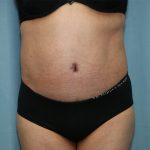 Tummy Tuck Before & After Patient #245