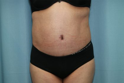 Tummy Tuck Before & After Patient #245