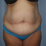 Tummy Tuck Before & After Patient #246