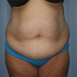 Tummy Tuck Before & After Patient #246