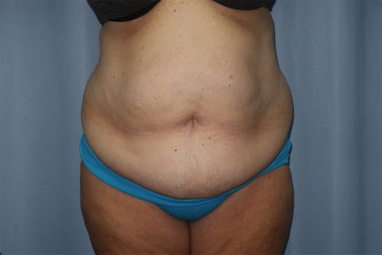 Tummy Tuck Before & After Patient #246