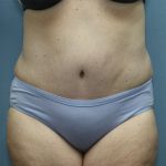 Tummy Tuck Before & After Patient #246