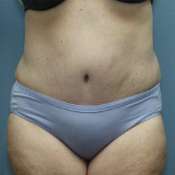 Tummy Tuck Before & After Patient #246