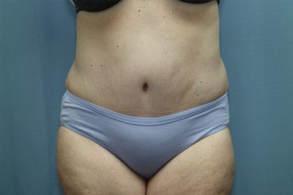 Tummy Tuck Before & After Patient #246