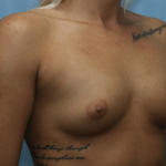 Breast Augmentation Before & After Patient #331