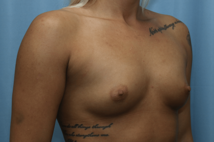 Breast Augmentation Before & After Patient #331