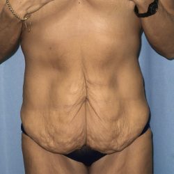 Tummy Tuck Before & After Patient #247