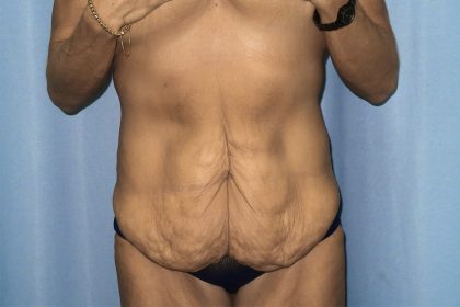 Tummy Tuck Before & After Patient #247