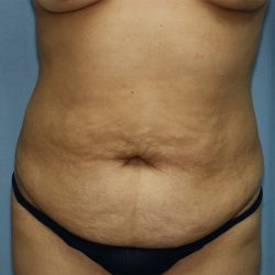 Tummy Tuck Before & After Patient #248