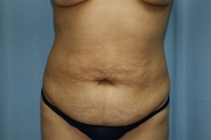 Tummy Tuck Before & After Patient #248