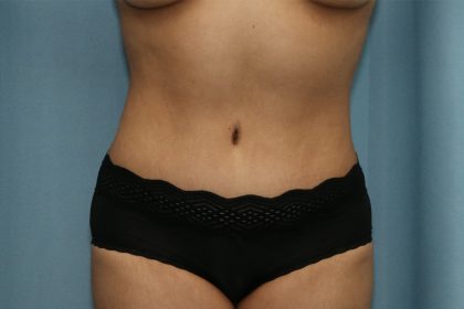 Tummy Tuck Before & After Patient #248