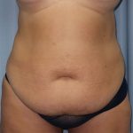 Tummy Tuck Before & After Patient #249
