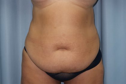Tummy Tuck Before & After Patient #249