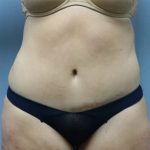 Tummy Tuck Before & After Patient #249