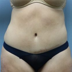 Tummy Tuck Before & After Patient #249