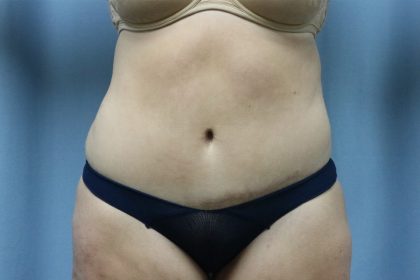 Tummy Tuck Before & After Patient #249