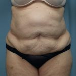 Tummy Tuck Before & After Patient #250