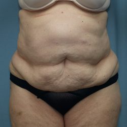 Tummy Tuck Before & After Patient #250