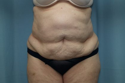 Tummy Tuck Before & After Patient #250