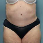 Tummy Tuck Before & After Patient #250