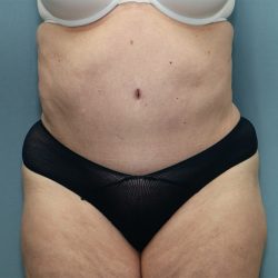 Tummy Tuck Before & After Patient #250