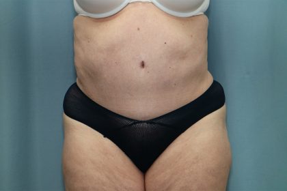 Tummy Tuck Before & After Patient #250