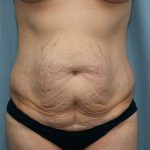 Tummy Tuck Before & After Patient #251