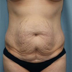 Tummy Tuck Before & After Patient #251