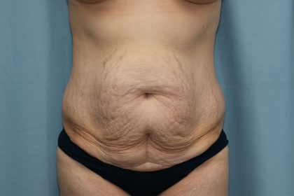 Tummy Tuck Before & After Patient #251