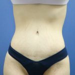 Tummy Tuck Before & After Patient #251