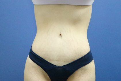 Tummy Tuck Before & After Patient #251
