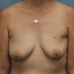 Breast Augmentation Before & After Patient #361