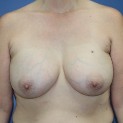 Breast Augmentation Before & After Patient #361