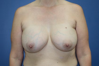 Breast Augmentation Before & After Patient #361