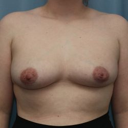 Breast Augmentation Before & After Patient #364