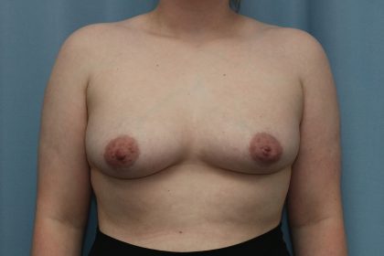 Breast Augmentation Before & After Patient #364