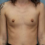 Breast Augmentation Before & After Patient #387