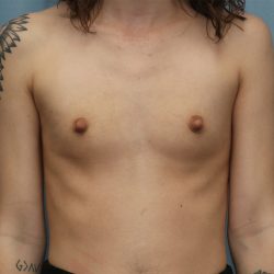 Breast Augmentation Before & After Patient #387