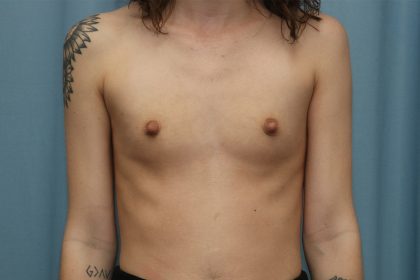 Breast Augmentation Before & After Patient #387