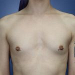 Gender-Affirming Care Before & After Patient #273