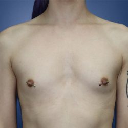 Gender-Affirming Care Before & After Patient #273