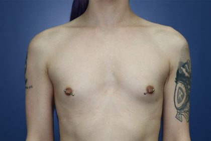 Gender-Affirming Care Before & After Patient #273