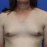Gender-Affirming Care Before & After Patient #274