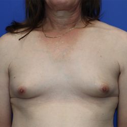 Gender-Affirming Care Before & After Patient #274