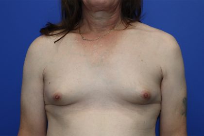 Gender-Affirming Care Before & After Patient #274